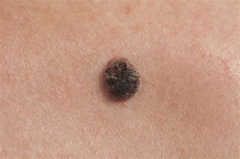 Skin Cancer Symptoms That You Shouldn t Ignore ...