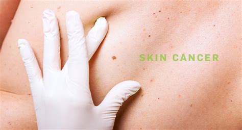 Skin Cancer Treatment l Non Melanoma Skin Cancer Sensus ...