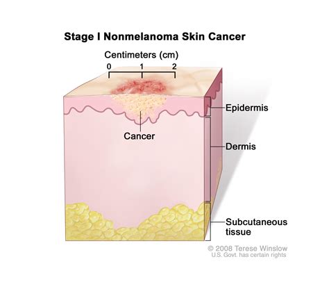 Skin Cancer Treatment  PDQ® —Patient Version   National ...