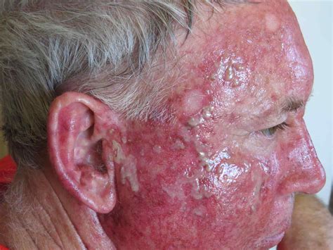 Skin Cancers Types | tommycat.info