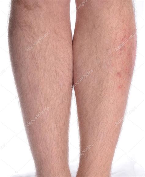 Skin Disease on the Leg — Stock Photo © LaCameraChiara ...