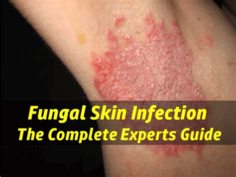 Skin Fungus Infection   Are You Treating The Cause or The ...