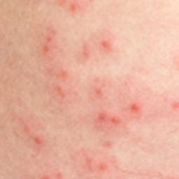 Skin rash: 56 pictures, causes, and treatments