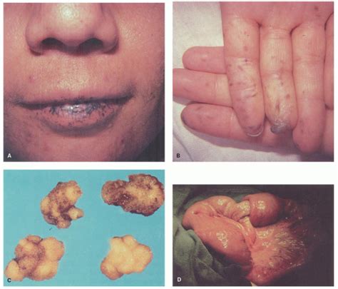 Small and Large Bowel Polyps and Tumors | Abdominal Key