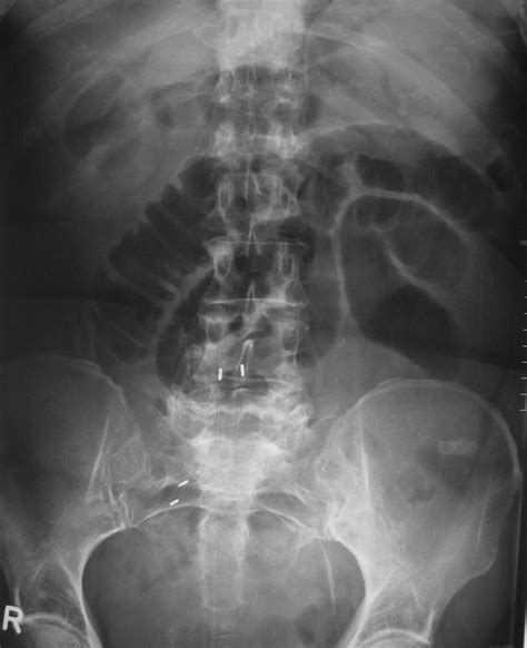 Small bowel obstruction   Radiology at St. Vincent s ...