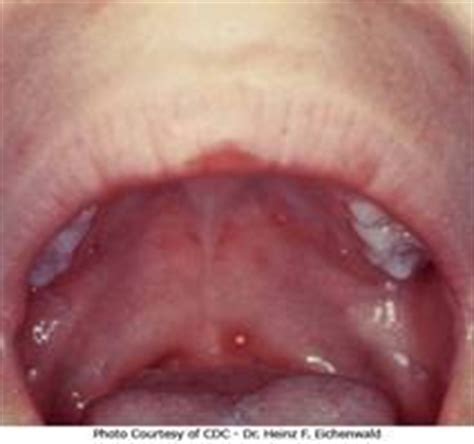 Soft Palate Cancer | Spain| PDF | PPT| Case Reports ...