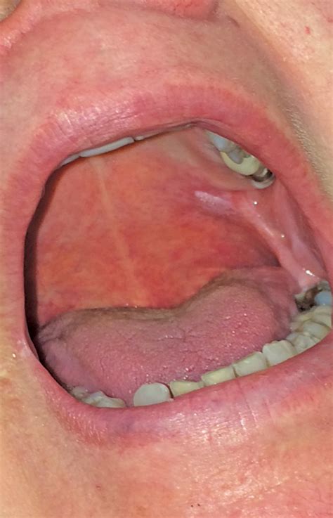 Soft Palate Cancer | Spain| PDF | PPT| Case Reports ...