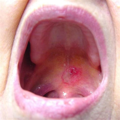 Soft Palate Ulcer Related Keywords   Soft Palate Ulcer ...