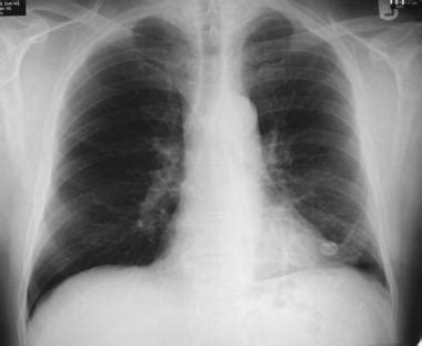 Solitary Pulmonary Nodule: Overview, Types of Benign ...