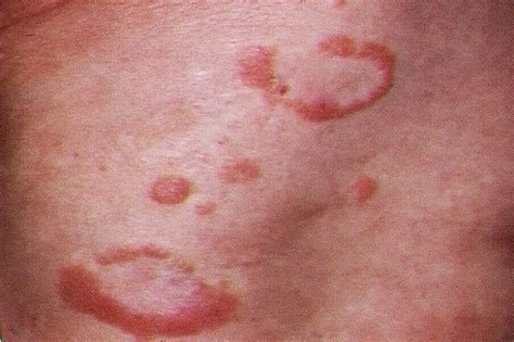 ¿Son contagiosos los hongos de la piel? | Remedios 10