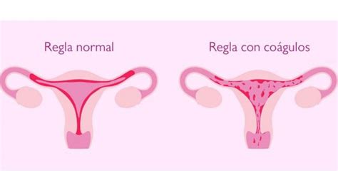 ¿Son normales los coágulos en la menstruación? Descubre la ...