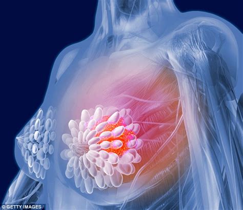 Soya limits the effectiveness of breast cancer treatment ...