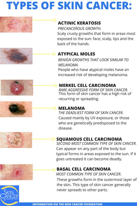 Spelling Out Skin Cancer | Advanced Dermatology Blog ...