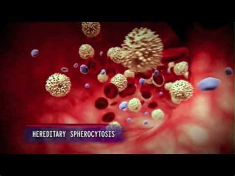 spherocytosis – Dictionary definition of spherocytosis ...