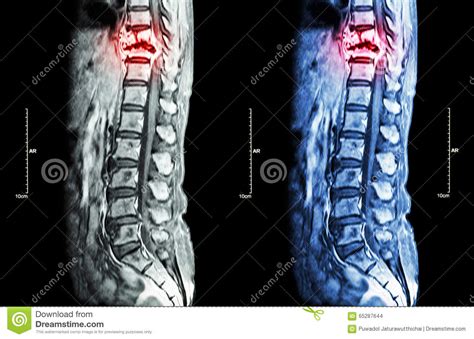 Spine metastasis stock photo. Image of backbone, magnetic ...