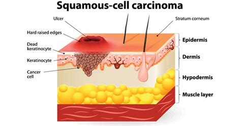 Squamous cell carcinoma of esophagus. Jill scott insomnia