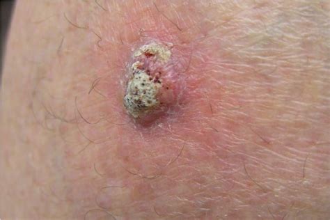 Squamous Cell Carcinoma   Treatment