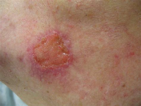 Squamous Cell Skin Cancer | tommycat.info