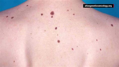 stage 1 melanoma skin cancer what causes melanoma cnn video
