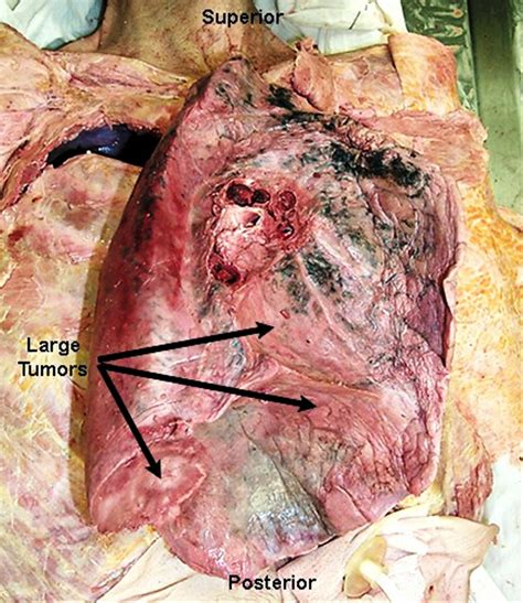 Stage 4 Lung Cancer Symptoms 117772 « MedicineBTG.com