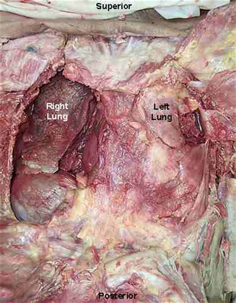 Stage 4 Non Small Cell Lung Cancer Survivors