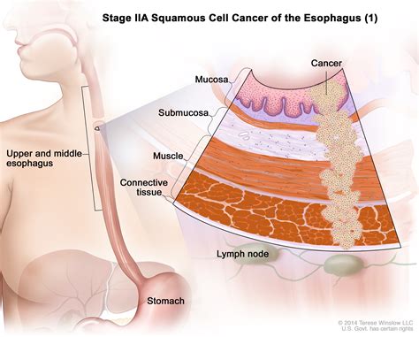 stage II esophageal squamous cell carcinoma  Patient ...