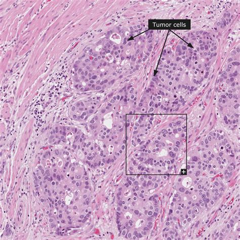 Stomach Cancer Carcinoma