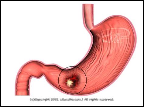 Stomach Cancer. Causes, symptoms, treatment Stomach Cancer