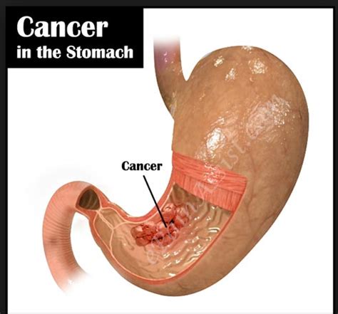 Stomach Cancer Images Reverse Search