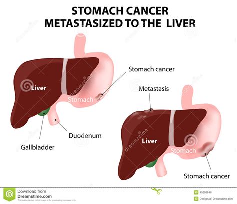 Stomach Cancer Metastasized To The Liver Stock Vector ...