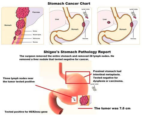 Stomach Cancer Stage | www.pixshark.com   Images Galleries ...