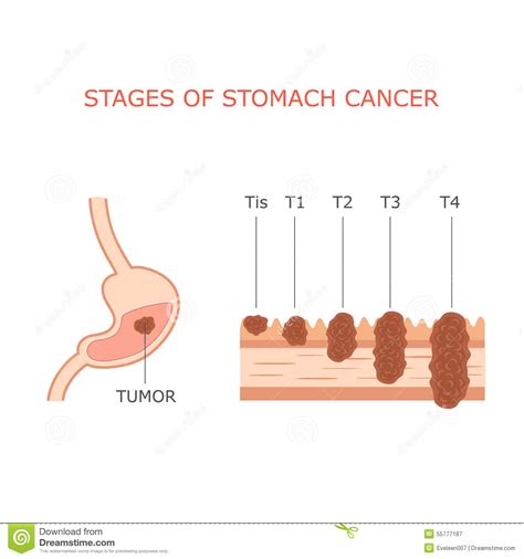 Stomach Cancer Staging