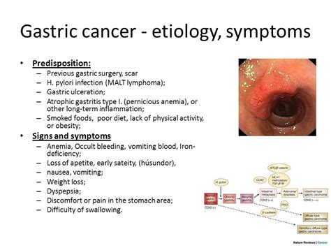Stomach Cancer Symptoms