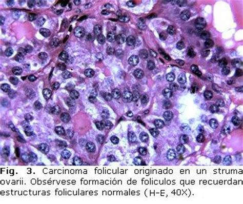 Struma ovarii, hallazgos de patología tiroidea en el ovario