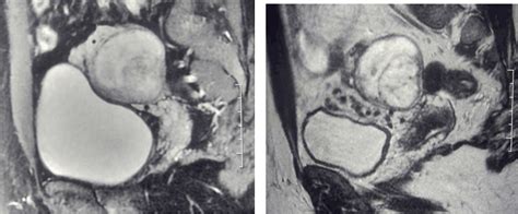 Struma Ovarii MRI imaging | Radiology Tips Blog