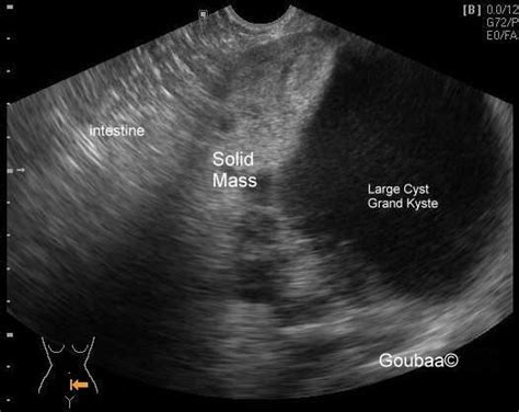 Struma Ovarii ultrasonography ovary goiter dermoid ...