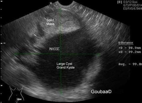 Struma Ovarii ultrasonography ovary goiter dermoid ...