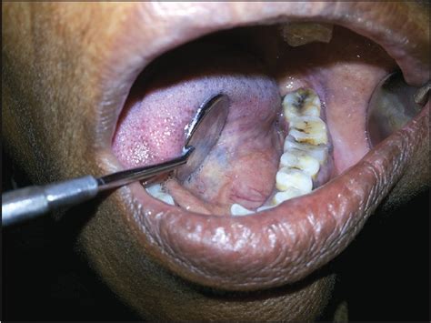 Submandibular gland swelling: A diagnostic dilemma Kumar T ...