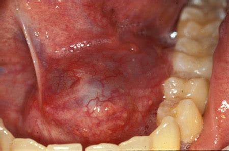 submandibular salivary gland swelling