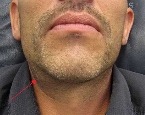 submandibular salivary gland swelling