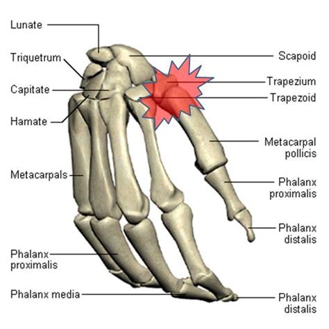 Surgery Alternative for Hand and Thumb Arthritis or Injury