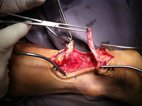 Surgery for an Achilles Tendon Rupture | Singapore Sports ...