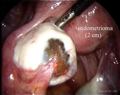 Surgery of cystic ovarian endometriosis | My Blog