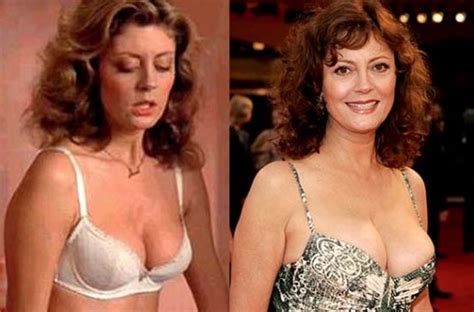 Susan Sarandon Plastic Surgery Before and After