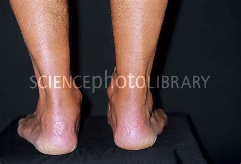 Swollen achilles tendon   Stock Image M330/1178   Science ...