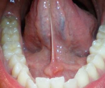 Swollen Gland under Tongue, Causes, Symptoms, white tongue ...