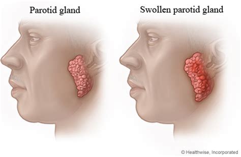 Swollen Parotid Gland | Metro Health