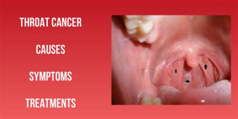 Symptoms, Causes and Treatments of Throat Cancer | Cancer ...