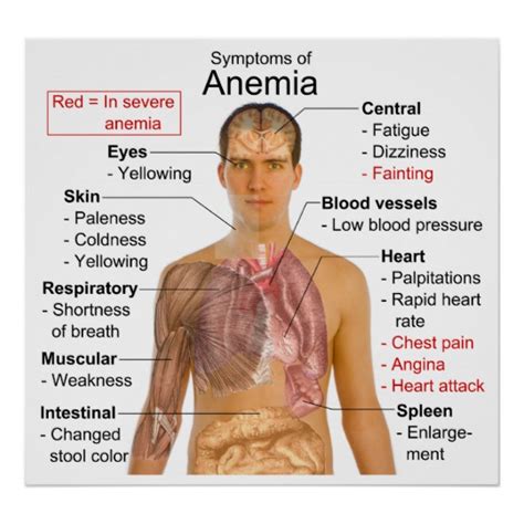 Symptoms Chart of the Blood Disease Anemia Poster | Zazzle