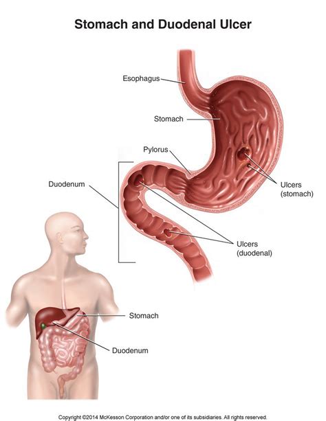 Symptoms Of Gastric Ulcers
